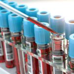 Test del sangue per scooprire il tumore ai testicoli quando i marcatori standard non vengono rilevati