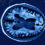 Nuove analisi con MRI rivelano assottigliamento regioni cerebrali collegate alla depressione