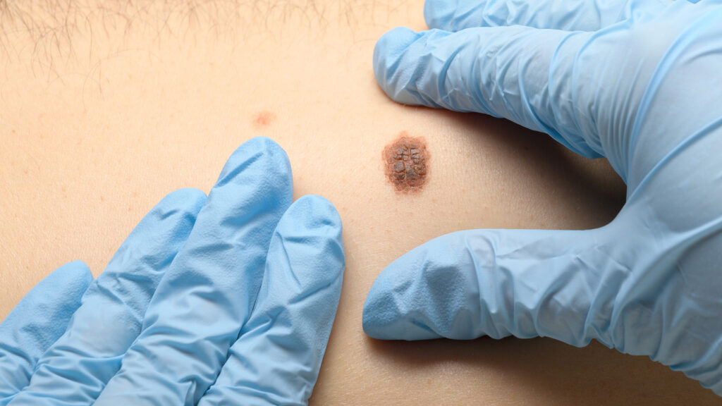 Melanoma: il nemico invisibile non è dove pensiamo