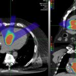 La terapia protonica può migliorare le opzioni di trattamento per un disturbo cardiaco pericoloso