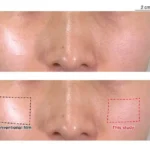 Indossabile  e invisibile: nuovi sensori cutanei che rivoluzionano il monitoraggio della salute