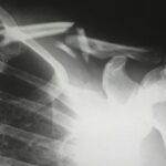 Dopo una frattura da fragilità, il supporto al paziente per accompagnare il trattamento